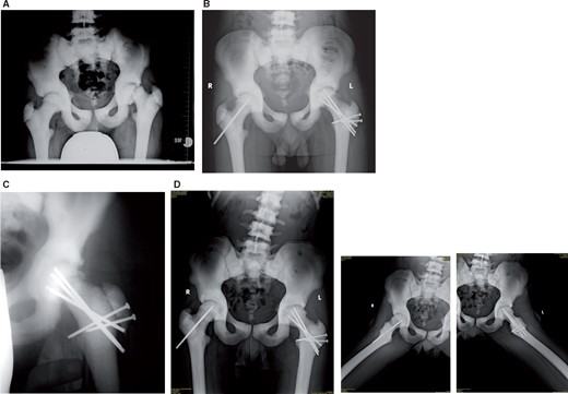 Subcapital realignment of a severe chronic slipped capital femoral epiphysis (SCFE) in a 12-year-old male. (A) Severe deformity, radiologically and clinically classified as unstable. (B) Result 2 months after subcapital realignement and prophylactic pinning of the contralateral epiphysis. The radiograph does not demonstrate the difficulties in avoiding distraction and fragment rotation during antegrade pinning. The solution was retrograde pinning, only revealed by the blunt pin ends in the epiphysis. (C) Trochanteric osteotomy line still visible at 5 months postoperatively. (D) At 3 years there are comparable hip contours of both hips, which are clinically normal. The projecting pin on the right may possibly be shortened if it troubles the patient when lying on his side.