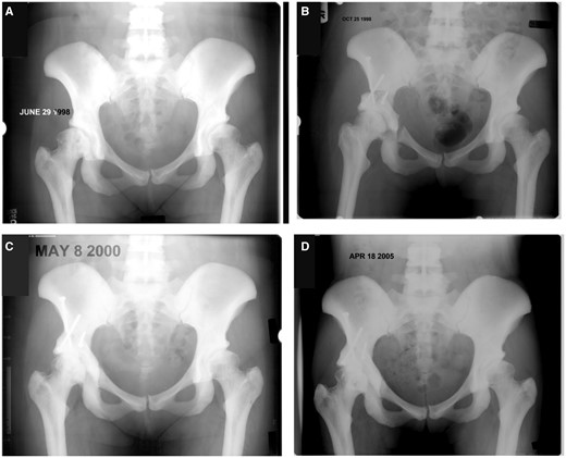 Periacetabular osteotomy for acetabular dysplasia. (A) Bilateral residual acetabular dysplasia. While the left hip is asymptomatic the right hip shows Grade 1–2 osteoarthritic changes with slight subluxation; on examination it demonstrated a painful limitation of range of movement. (B) Pelvic radiograph shortly after periacetabular osteotomy showing normalized coverage and reduction of the femoral head. (C) Radiography 18 months after surgery. The main osteotomies are consolidated and the pubis gap is narrowed. (D) Radiograph six-and-a-half years after surgery with slightly decreased superior joint space. The patient reported some discomfort, although only after longer lasting physical activities.