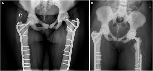 Total hip replacement (THR) in a 37-year-old female after two bilateral femoral shaft fractures and a head split on the left. (A) On both sides there is one remaining threaded screw part left in place from steel plate fixation of the first fracture. For the second, more proximal fractures on both sides longer plates were used in order to bridge the screw holes. On the left, the implantation of the long screw in the femoral neck was complicated by a split fracture of the head during final seating of the screw against high resistance. The screw was shortened and the head split fixed with small screws. One year later the lateral part of the head collapsed and the joint space narrowed. (B) For THR, removal of the implant was necessary. Cutting of the proximal part of the plate using a high speed diamond saw was preferred to the more laborious attempts to remove the full length of plate and screws. Reaming of a new medullary canal was possible but very time consuming. A thin, conical prosthesis shaft was securely inserted without fracturing the surrounding bone.