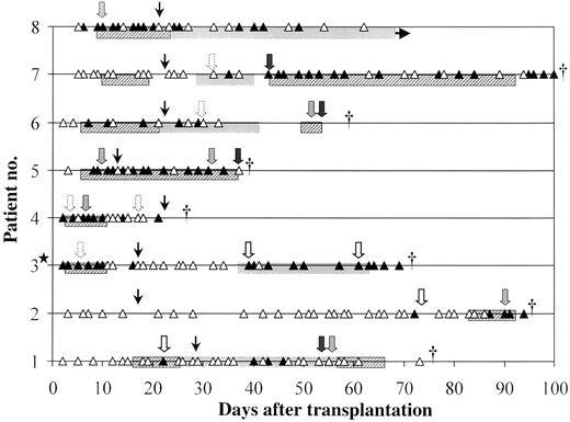 Correlation of polymerase chain reaction (PCR) results and clinical evidence among 8 continuously screened patients with proven or probable invasive aspergillosis (IA). ▲. Positive PCR result (days 1–100 after transplantation); △, negative PCR result (days 1–100 after transplantation); ★, patient with proven IA before transplantation; dotted arrows, pulmonary infiltrate (chest radiograph); open arrows, nonspecific infiltrates (computed tomography); shaded arrows, nodular infiltrates (computed tomography); solid arrows, cerebral lesions; narrow arrows, date laminar air flow was stopped; hatched bars, intravenous amphotericin B; and shaded bars, itraconazole. † Time of death.