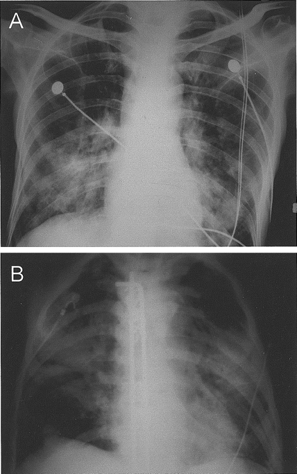 Chest radiographs of the 2 patients who died of coronavirus HKU1–associated community-acquired pneumonia. The chest radiograph of the first patient (A) (patient 2 in table 2) showed patchy airspace shadows in both lungs, with predominant involvement of the lower zones. The chest radiograph of the second patient (B) (patient 10 in table 2), with Luque instrumentation in situ, showed extensive airspace shadows in both lungs, with the middle zones more severely involved