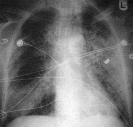 Radiographic evidence of severe pneumonia in human metapneumovirus (hMPV) infection. A representative chest radiograph from a patient with hMPV isolated from a bronchoalveolar lavage fluid sample (patient 2 in table 4) indicates diffuse pulmonary infiltrates with consolidation, particularly in the lingula and right lower lobe