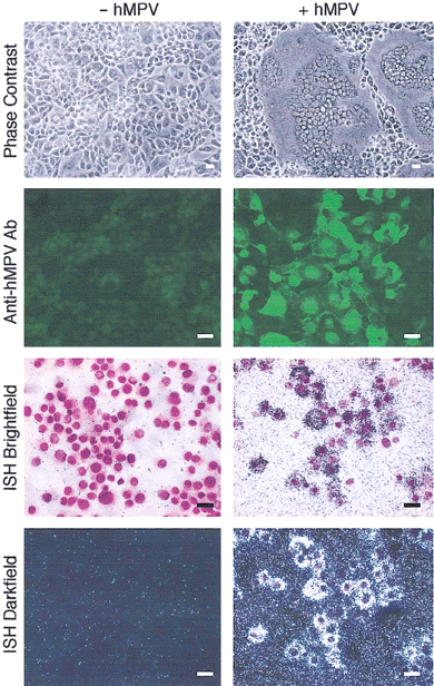 Detection of human metapneumovirus (hMPV) infection in cell culture. Cultured rhesus monkey kidney LLC-MK2 cells were inoculated with either hMPV (+ hMPV) or a control (− hMPV) and then were incubated at 37°C for 5 days. Cells were then subjected to phase-contrast microscopy (first row) at 5 days after inoculation, immunofluorescence microscopy with patient convalescent-phase serum (1:100 dilution) and fluorescein isothiocyanate–conjugated goat anti-human IgG (second row) at 2 days after inoculation, and in situ hybridization (ISH) with 35S-labeled antisense probe for viral nucleocapsid gene mRNA under brightfield (third row) and darkfield microscopy (fourth row) at 2 days after inoculation. Scale bars, 20 μm. Ab, antibody
