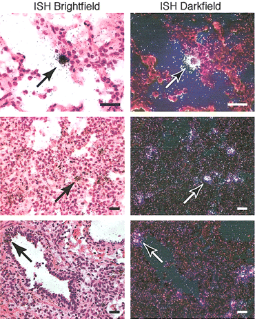 Detection of human metapneumovirus (hMPV) infection in lung tissue. The open lung biopsy sample from patient 1 was subjected to in situ hybridization (ISH) for hMPV mRNA and brightfield and darkfield microscopy, as described in figure 2. Arrows indicate alveolar epithelial cells (first and second rows) and bronchial epithelial cells (third row) with a positive signal above background levels. Scale bars, 20 μm