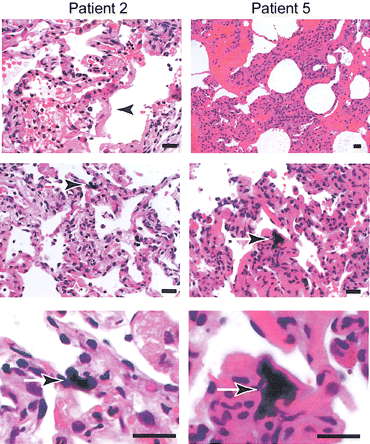 Photomicrographs of human metapneumovirus (hMPV) infection in lung tissue. Representative photomicrographs are shown for hematoxylin-eosin staining of transbronchial biopsy samples from patients with hMPV infection (patients 2 and 5). Arrows indicate the hyaline membrane formation (first row) and smudge cells (second row and corresponding higher magnification in third row). Scale bars, 20 μm
