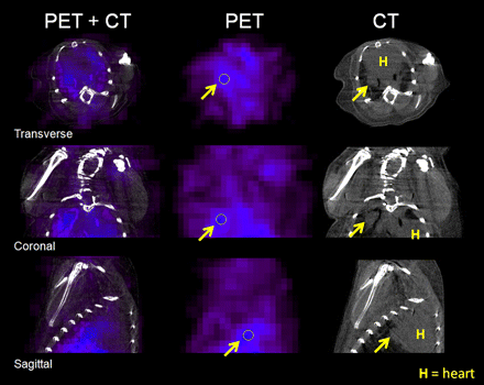 Copper(II)-diacetyl-bis(N4-methyl-thiosemicarbazone) ([64Cu]ATSM) is localized to tuberculosis lesions of C3HeB/FeJ mice. Transverse, coronal, and sagittal computed tomographic (CT) and positron emission tomographic (PET) images from a Mycobacterium tuberculosis–infected C3HeB/FeJ mouse lung during the chronic phase of infection are shown. In the right panel (CT), the tuberculosis lesion is seen as a consolidation (gray) just posterior to the heart (H) (arrows). The middle panel (PET) shows the corresponding [64Cu]ATSM PET images. The arrows point to areas of high [64Cu]ATSM PET activity and the region of interest (encircled). The left panel (PET plus CT) shows the colocalization of the [64Cu]ATSM PET signal and the tuberculosis lesion seen on the CT images.
