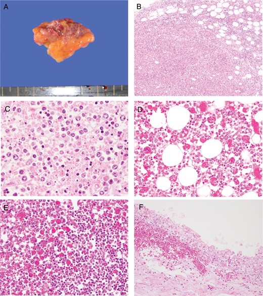 Macroscopic and microscopic findings under hematoxylin-eosin staining. A, Gross appearance of the swollen right axillary lymph node (3.5 × 2.0 cm). B and C, Microscopic findings in the right axillary lymph node. The basic architecture of the lymph node has been replaced by massive necrosis. The necrotic regions contain histiocytes, immunoblasts, nuclear debris, and eosinophilic ghosts but no neutrophils. D and E, Marked erythrophagocytosis in the bone marrow (D) and spleen (E). F, Acute subepithelial hemorrhage in the renal pelvis.