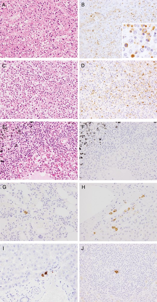 Microscopic and immunohistochemical tissue images. Hematoxylin-eosin staining (A, C, and E) and subsequent immunohistochemical analysis reveal the presence of severe fever with thrombocytopenia syndrome virus (SFTSV) NP (B, D, F, G, H, I, and J) in the right axillary (A and B), right cervical (C and D), and the mediastinal (E and F) lymph nodes. A, C, and E, Infiltration by immunoblasts and prominent hemophagocytosis was generally observed in the right axillary, right cervical, mediastinal, hilar, and abdominal lymph nodes; however, necrosis was only observed in the right axillary and cervical lymph nodes. B, D, and F, Viral antigen–positive cells were detected in the right axillary and cervical lymph nodes. Positive signals for SFTSV NP antigen were detected in the cytoplasm of blastic cells (B; inset). Inset shows a higher magnification (40×). In contrast, no signals were detected in the mediastinal lymph nodes, regardless of immunoblast infiltration and hemophagocytosis. G, H, I, and J, Immunohistochemical analysis of SFTSV NP was performed in the bone marrow (G), adrenal glands (H), liver (I), and spleen (J). A few SFTSV antigen–positive cells were observed in these tissues, with no notable cytopathic effects or necrosis (magnification, 20×; inset, 40×).
