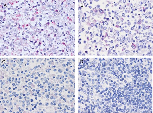Detection of severe fever with thrombocytopenia syndrome virus (SFTSV) RNA in the right cervical lymph node by the in situ hybridization AT-tailing method. A, SFTSV genomic RNA was detected in the right cervical lymph node by the in situ hybridization AT-tailing method and a sense probe. SFTSV genomic RNA was detected in the cytoplasm of the blastic cells. B, The in situ hybridization AT-tailing method with an anti-sense probe detected a few cells in the right cervical lymph node that were positive for SFTSV messenger RNA (mRNA). SFTSV mRNA was also detected in the cytoplasm of blastic cells. C, No signals were detected in the right axillary lymph node by the in situ hybridization AT-tailing method with an irrelevant probe (negative control). D, A SFTSV sense probe detected no signals in lymph node sections showing necrotizing lymphadenitis without SFTSV infection.