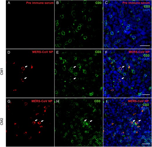 Middle East respiratory syndrome coronavirus (MERS-CoV) infects CD3+ T cells in the spleen of infected common marmosets. Immunostaining was performed on paraformaldehyde-fixed and paraffin-embedded sections of spleen obtained on day 1 after virus challenge of animals. Colocalization between MERS-CoV nucleoprotein (NP; D and G) and CD3 (E and H) were detected in the spleen of the infected animals (arrows; D–F and G–I). CM1 and CM2 represent 2 individual common marmosets. MERS-CoV NP was not detected in the preimmune serum control (A–C). Bars represent 25 µm.