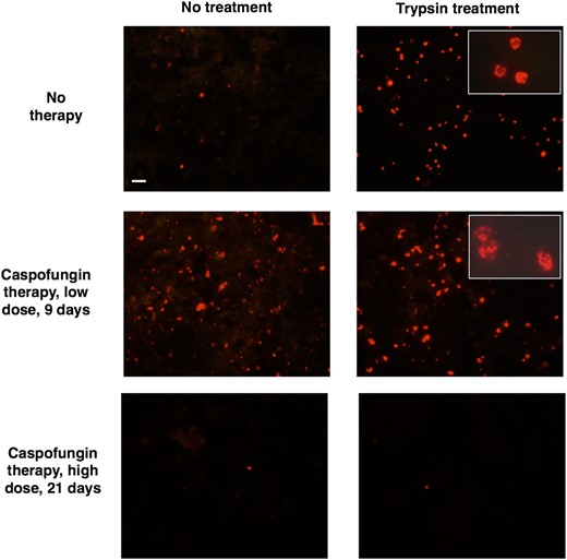 Immunofluorescence microscopy of β-1,3-glucan in Pneumocystis murina organisms following caspofungin treatment. Mice infected with P. murina were untreated (top), treated with caspofungin 30 µg/kg for 9 days (middle), or treated with caspofungin 10 mg/kg for 21 days (5 days per week; bottom). Partially purified P. murina organisms were evaluated for β-1,3-glucan exposure, using Alexa Fluor 594–conjugated factor G. Untreated controls showed only rare labeling of cysts without trypsin treatment, while the group treated with caspofungin for 9 days showed labeling of many cysts prior to trypsin treatment. Both groups had large numbers of labeled cysts after trypsinization. Following 21 days of caspofungin treatment, very few cysts were detected either prior to or following trypsin treatment. All large panels, 400× original magnification. Insets show high-power (1000× original magnification) magnification of cysts to demonstrate the altered cyst structure associated with caspofungin treatment. Bar, 20 µm.