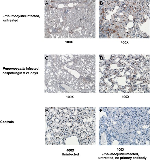 Immunohistochemical labeling of mouse lungs for macrophages. To examine the differences in macrophage presence and distribution in lungs from untreated infected mice and mice treated with caspofungin, Pneumocystis-infected and control mouse lungs were labeled with murine macrophage marker anti-F4/80; representative sections are shown here. A–D, Left panels are low-power images (100× original magnification), and right panels are high-power images (400× original magnification) of untreated infected control lung (top row) and caspofungin-treated infected lung (middle row). Macrophages, labeled reddish brown with variable intensity in their membranes and cytoplasm, are denoted with black arrowheads. Caspofungin-treated mouse lungs contained lesser numbers of macrophages overall and in particular an absence of aggregates of macrophages around larger airways. E and F, The bottom row shows controls, including uninfected lung (left) and Pneumocystis-infected lung exposed to all reagents except the primary antibody (right), with both images at high power. Uninfected mouse tissue (E) shows low numbers of macrophages that are normally resident in mouse lung. Bars, 200 µm (A) and 50 µm (B and E).