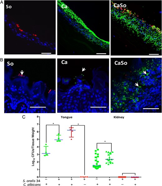 Streptococcus oralis increases Candida albicans oral mucosal invasion in vitro and in vivo. A, B, Mucosal analogues (A) or tongue tissues (B) infected with S. oralis 34 (So), C. albicans SC5314 (Ca) or both in combination (CaSo). Mucosal analogues were infected for 16 hours and tongues were excised 4 days' after infection. Representative tissue sections are shown where C. albicans (green) was visualized after staining with a fluorescein isothiocyanate–conjugated anti-Candida antibody and S. oralis (red) was visualized after fluorescence in situ hybridization with a Streptococcus-specific probe conjugated to Alexa 546; mucosal cell nuclei were counterstained with the nucleic acid stain Hoechst 33258 (blue). Overlay of 3-color images shows the position of organisms on the superficial or deeper layers of the oral mucosa (arrows). Bars represent 50 µm. C, Recovery of C. albicans and S. oralis from tongues and kidneys. Tongues and kidneys were homogenized, serially diluted and plated for C. albicans (green) or S. oralis (red) colony-forming unit (CFU) counts. Mice were killed 4 or 5 days after infection; tongues were collected on day 4, and kidneys on day 5. Log CFU counts are shown from up to 3 independent mouse experiments, with 4–8 mice per group; bars represent means with standard deviations, *P < .05 (comparison between Ca and CaSo groups). This figure is available in black and white in print and in color online.