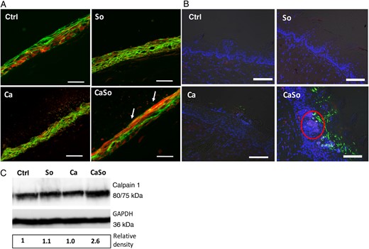 Calpain 1 is increased in mucosal constructs and tongue tissues during coinfection. A, Immunofluorescence stain for calpain 1 (red) and E-cadherin (green) in OKF6/TERT-2 mucosal constructs after 16 hours of infection. Arrows indicate increased red and decreased green fluorescence intensity in the superficial layers of mucosal analogues infected with both organisms. Bars represent 50 µm. B, Overlay images of mouse tongue tissue sections stained for calpain 1 (red) and Candida albicans (green) and counterstained with nucleic acid stain Hoechst 33258 (blue). Tongues were excised on day 4 after infection. Red circle indicates area of increased calpain expression adjacent to invading fungal organisms. C, Calpain 1 protein levels were detected in tongue tissue homogenates of mice by means of Western blotting. Glyceraldehyde-3-phosphate dehydrogenase (GAPDH) was used as an internal loading control. Numbers under each lane represent relative image density, calculated as described for Figures 2 and 3. Bars represent 50 µm. Abbreviations: Ca, C. albicans SC5314 only; CaSo, C. albicans SC5314 and Streptococcus oralis 34 in combination; Ctrl, uninfected group; So, S. oralis 34 only. This figure is available in black and white in print and in color online.