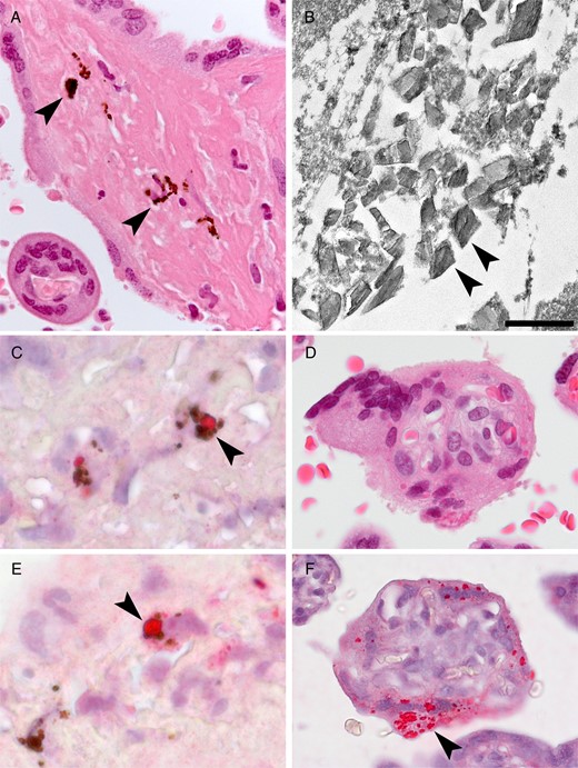 Placental findings from patient 1. A, Hemozoin (malarial parasite pigment) in fibrin (arrowheads). B, Transmission electron microscopy showing malarial parasite hemozoin crystallites (arrowheads); no ebolavirus virions were identified. Scale bar = 500 nm. C, Colocalization of ebolavirus antigen (arrowheads) with malarial parasite pigment. D, Serial sections by hematoxylin-eosin staining (upper) and immunohistochemical staining (lower) showing ebolavirus antigen (arrowhead) localized to the syncytiotrophoblast.
