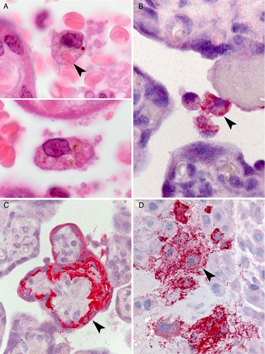 Placental findings from patient 2. A, Circulating atypical maternal macrophages with vacuolated cytoplasm and eosinophilic cytoplasmic granules suggestive of viral inclusions (arrowhead). By immunohistochemical staining, ebolavirus antigen was found to localize to circulating maternal macrophages (B), syncytiotrophoblast (C), and intermediate trophoblast within the basal plate (D; arrowheads).