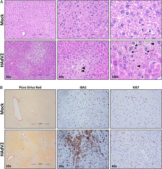 Liver pathology analysis in mice with acute human adenovirus (HAdV) infection. Representative micrographs of liver sections from HAdV2-infected and mock-infected humanized NSG-A2 mice, stained with hematoxylin-eosin (A) and Picro Sirius Red (B), which was used to stain collagen in damaged livers, highlighting fibrotic tissue; IBA1 antibody, which was use to stain monocytes/macrophages; and Ki67 antibody, which was used to mark proliferating cells. Arrowheads indicate cells lacking a nucleus. Arrows highlight vacuolization in hepatocytes. Scale bar represents 0.5 µm in all magnifications.