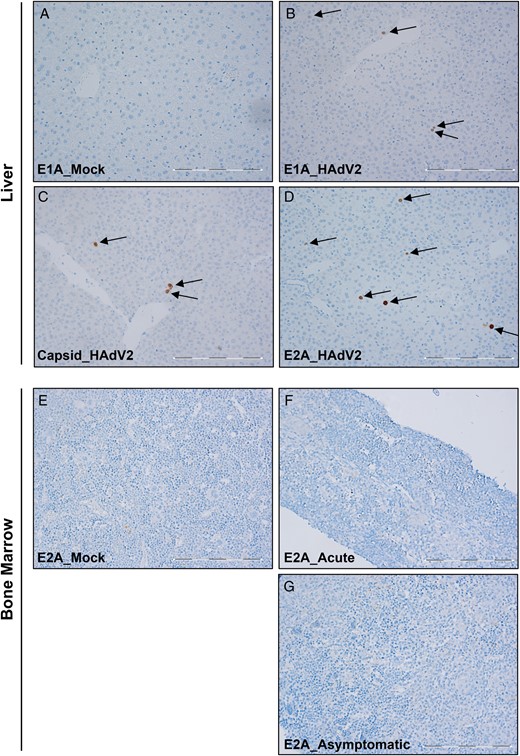 Detection of human adenovirus (HAdV) proteins in liver and bone marrow. E1A, E2A, and capsid proteins in formalin-fixed, paraffin-embedded tissue samples underwent immunohistochemical analysis. A–D, Representative micrographs of liver sections from mice with acute infection, showing results of E1A staining (A and B), capsid staining (C), and E2A staining (D). E–G, Representative micrographs of bone marrow sections stained with E2A antibody, showing results for mock-infected mice (E), mice with acute infection (F), and mice with asymptomatic infection (G). Arrows point to cells that stained positive for each antibody. The scale bar is 0.5 µm. All pictures were taken at 20 times the original magnification.