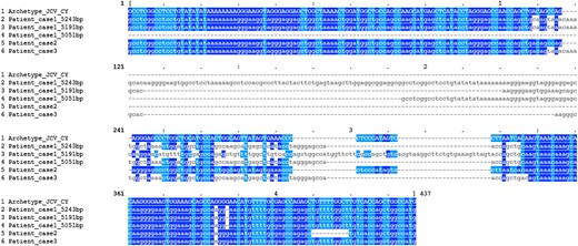 Alignment of the noncoding regulatory regions (NCCR) of patient JC polyomavirus (JCPyV) strains and the CY archetype strain. NCCR sequences of mutant JCPyV strains were compared with the archetype NCCR sequence of the CY prototype strain (in capital letters). Three NCCR sequences were found in the sample from patient 1 (5243, 5191, and 5051 base pairs) but only 1 NCCR sequence in samples from both patients 2 and 3. Sequence identities are highlighted either in dark blue (nucleotides A and G) or light blue (nucleotides C and T).