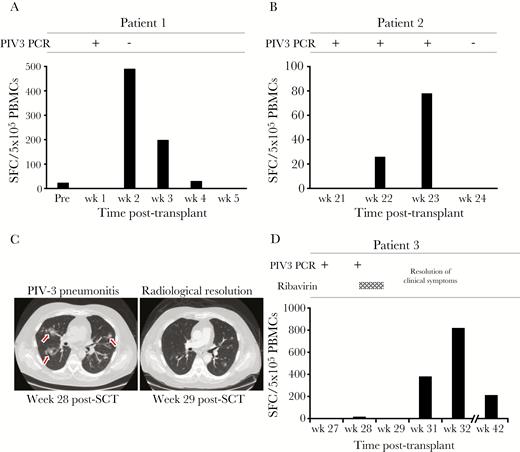 Detection of parainfluenza virus 3 (PIV3)–specific T cells in the peripheral blood of hematopoietic stem cell (HSCT) recipients who controlled PIV3 infection. Peripheral blood mononuclear cells (PBMCs) isolated from 3 HSCT recipients during an acute PIV3 infection were tested for specificity against our panel of PIV3 antigens, using interferon-γ enzyme-linked immunospot assay as a readout. A, B, and D, Results from 3 patients in whom PIV3 infection was rapidly controlled, coincident with a detectable rise in PIV3-specific T cells. C, Axial computed tomography scan of the lungs (patient 3) displaying multifocal patchy ground-glass nodular infiltrates that resolved within 1 week. Abbreviations: PBMC, peripheral blood mononuclear cell; PCR, polymerase chain reaction; PIV3, parainfluenza virus 3; SCT, stem cell transplant; SFC, spot-forming cell.
