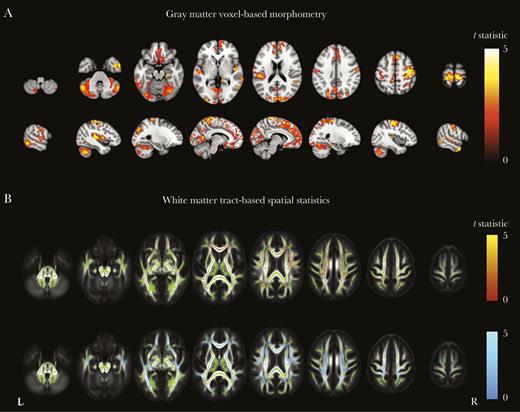 Gray matter voxel-based morphometry and white matter tract-based spatial statistics among persons living with human immunodeficiency virus (PLWH), with or without prior AIDS, as compared to HIV-negative individuals. A, Regions where gray matter volume was significantly lower among PLWH with prior clinical AIDS (reference group, HIV-negative individuals). B, Areas where fractional anisotropy was significantly lower among PLWH without prior clinical AIDS (red; top row) and those with prior clinical AIDS (blue; bottom row), compared with HIV-negative individuals. Areas are colored by the t statistic, corrected for multiple comparisons and adjusted for age, scanner type, and intracranial volume. Significant differences (P < .05) are overlaid on the gray matter or the mean fractional anisotropy image (gray scale) and the white matter skeleton (green).