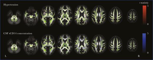 White matter tract-based spatial statistics of hypertension and cerebrospinal fluid (CSF) soluble CD14 (sCD14) concentration in all participants. Shown are regions where fractional anisotropy negatively correlates with hypertension (top row) and CSF sCD14 concentration (bottom row) for all participants (P < .05). Areas are colored red (hypertension) or blue (CSF sCD14 concentration), based on the t statistic, corrected for multiple comparisons and adjusted for age, scanner type, intracranial volume, and human immunodeficiency virus (HIV) serostatus. Significant differences are overlaid on the white matter skeleton (green) and the mean fractional anisotropy image (gray scale).