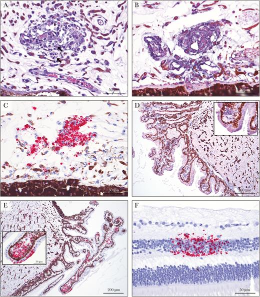 Histopathology of the eye in Marburg virus (MARV) infection. A, A venule in the iris is partially occluded by an embolus of viable, degenerate, and necrotic vacuolated macrophages, with infiltration of macrophages into the surrounding perivascular stroma and mild edema. There are rare viral intracytoplasmic inclusion bodies (arrows) (hematoxylin-eosin staining). B, Immunolabeling for MARV glycoprotein (GP) is positive in intravascular and extravascular macrophages and interstitial fibroblasts in the iris (nitroblue tetrazolium and 5-bromo-4-chloro-3-indolyl-phosphate chromagen and hematoxylin counterstain). C, MARV genome in situ hybridization (ISH) labels iridial fibroblasts and intravascular and extravascular macrophages, with scattered non–cell-associated staining (red substrate chromagen and hematoxylin counterstain). D, Positive immunostaining for MARV GP is present in morphologically normal ciliary body epithelium, stromal fibroblasts, and smooth muscle cells. Inset shows higher magnification of positive ciliary epithelium and stroma. E, Positive ISH findings for MARV genome in the epithelial cells, smooth muscle, and stroma of the ciliary body. Inset shows higher magnification of ciliary epithelium and stroma. F, Discrete foci of MARV genomic RNA are present in the inner nuclear layer of the retina.