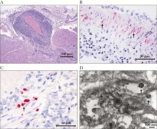Representative images of histopathology, immunohistochemistry (IHC), in situ hybridization (ISH), and electron microscopy. (A) Histopathology of severe lymphoplasmacytic and histiocytic arteritis and periarteritis of a coronary artery in the heart from strain 13 guinea pigs (GPS13) 2 inoculated with wild-type Lassa virus Josiah strain (wtLASV-J), days postinfection (dpi) 41. Hematoxylin and eosin stain: (B) IHC demonstrates that the smooth muscle cells in the tunica media of the mesenteric artery are strong positive for LASV antigen (black arrows, red chromogen), from GPS13 2 inoculated with wtLASV-J, dpi 41; (C) the smooth muscle cells in the tunica media of the mesenteric artery from GPS13 2 inoculated with wtLASV-J, dpi 41, are positive (black arrow, red chromogen) for LASV genomic ribonucleic acid by ISH; (D) electron micrograph from the tunica media of an artery in the pancreas from GPS13 2 exposed to wtLASV-J, dpi 41. Lassa virions (black arrows) were approximately 100 nm in diameter and had granular cores. Budding virus particles were seen (black arrowhead).