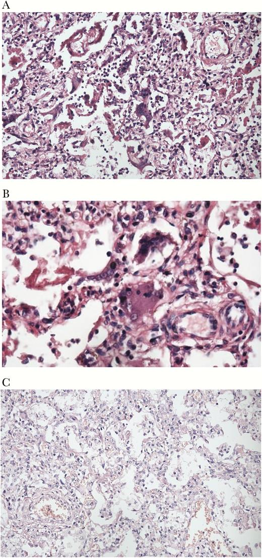 Hematoxylin and eosin stained specimens of lung tissue from 2 fatal measles cases. A, Interstitial pneumonia pattern with Hecht’s giant cells in a fatal measles patient that was hospitalized during the measles incubation period, but for a diagnosis other than pneumonia or influenza (×20). B, Specimen from the same patient as in (A), at ×40, with Hecht’s giant cells. C, interstitial pneumonia pattern without Hecht’s giant cells in a fatal measles patient that was hospitalized during the measles incubation period for influenza.