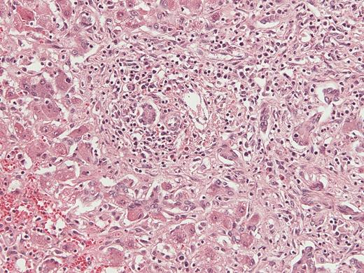 Histologic appearance of liver tissue in a patient who presented with vomiting and fatigue, found to have liver failure of unknown etiology and human herpesvirus 6 detected in the liver explant (case 30A). Hematoxylin and eosin stained sections demonstrate cholestasis, extensive parenchymal infiltration by small lymphocytes, bile duct proliferation, and hepatocellular damage with granulated cytoplasm, consistent with an acute viral infection. Magnification × 200.