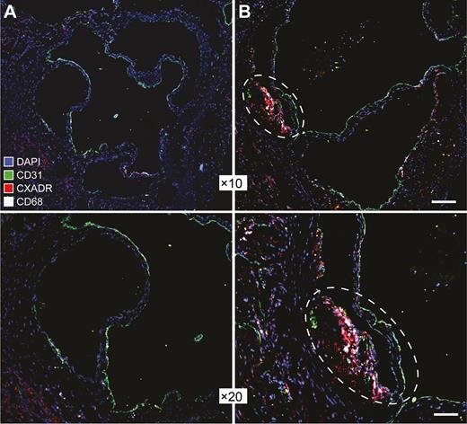 Up-regulation of coxsackievirus and adenovirus receptor (CXADR) in aortic plaques in a mouse model of atherosclerosis. Representative immunofluorescent images showing staining of CXADR (red) in aortic walls from 10-week-old (A) or 50-week-old (B) Ldr−/−Apob100/100 mice. Endothelial cells and macrophages were stained with antibodies against CD31 (green) and CD68 (white), respectively. Cell nuclei were labeled with DAPI (blue). A plaque lesion in the aortic wall of a 50-week-old mouse is enclosed in a dashed oval (right-hand images). Images were obtained with a digital camera and processed with NIS-Elements software (version 4.0; https://www.microscope.healthcare.nikon.com/products/software/nis-elements). Scale bars represent 60 μm (×10 magnification images) and 30 μm (×20 magnification images).