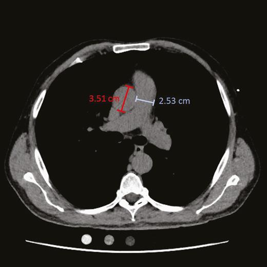 Chest computed tomographic scan of a study participant. The diameters of the main pulmonary artery (blue) at the level of its bifurcation and of the ascending aorta (red) in its maximum dimension were measured on the same image.