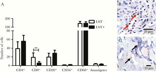 Inflammatory cells and amastigotes in biopsies from Leishmania skin test (LST)-negative and LST-positive patients. A, Number of T lymphocytes (CD4+, CD8+), B cells (CD20+), NK cells (CD56+), macrophages (CD68+), and amastigotes. Statistical analysis was performed using unpaired Student t test; ** P < .001. Bars represent mean and standard error; n = 25. B, CD8+ T cells (red arrows) stained (×40) and (C) Leishmania amastigotes (black arrows; 100×). Anti-CD20, anti-CD68, anti-CD56, anti-CD4, anti-CD8 (DAKO) and anti-Leishmania (in house). Mouse and rabbit peroxidase kit/horseradish peroxidase (Diagnostic BioSystems) were used to perform the detection.