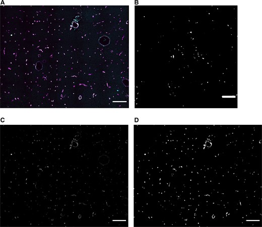 Example of acquired 4-color image and thresholding result. A, Sections were slide scanned and stored as 4-color images. This image is a small part of the scanned and analyzed area. B, Sequestration of Plasmodium falciparum was confirmed by using polarization microscopy. C, Image containing CD34+ vessels. This is used to detect brain vessels. (Also shown in white in A.) D, A mask of the image in C. Scale bars = 200 μm.