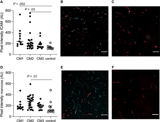 Intercellular adhesion molecule 1 (ICAM-1) and mannose are increased in cerebral capillaries in patients with cerebral malaria (CM). A, CM1 as well as CM2 had significantly higher ICAM-1 expression as compared to non-CM controls (P = .002 and P = .03). B, Representative image of ICAM-1 expression in CM1. CD34 is shown in red; ICAM-1 is marked in cyan. C, Representative image of ICAM-1 expression in non-CM controls. CD34 is shown in red; ICAM-1 is marked in cyan. D, Vascular mannose expression was increased in vessels when comparing across groups and CM2 had significantly higher levels of mannose residues when compared with non-CM controls (P = .01). E, Representative image of mannose expression in CM2. CD34 is shown in red; mannose is marked in cyan. F, Representative image of mannose expression in non-CM controls. CD34 is shown in red; mannose is marked in cyan. Scale bars = 100 μm. Images represent the median values in the groups. In A and D, each dot represents a subject. The median value is marked with a line, and bars show the interquartile ranges.