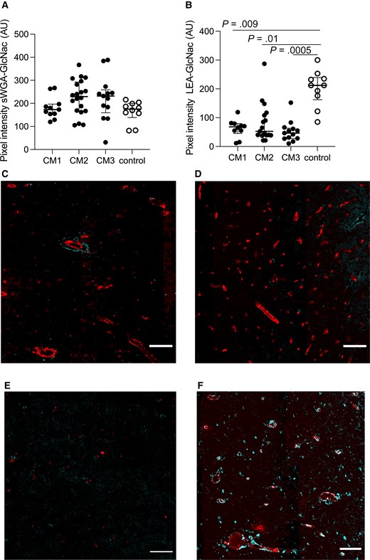 Specific regulation of N-acetyl glucosamine (GlcNac) residues on brain vessels. A, No significant changes for succinylated wheat germ agglutinin (sWGA)–specific GlcNac epitopes were seen. B, Tomato lectin (LEA)–specific GlcNac epitopes were significantly decreased in all 3 cerebral malaria (CM) groups (CM1: P = .009; CM2: P = .01; CM3: P = .0005). C–F, Representative images of LEA-specific GlcNac expression in cyan, overlaid with CD34 in red, in CM1 (C), CM2 (D), CM3 (E), and non-CM controls (F). Scale bars = 100 μm. Images represent the median values in the groups. In A and B, each dot represents a subject. The median value is marked with a line, and error bars show the interquartile ranges.