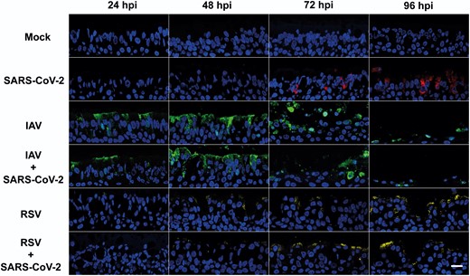 Virus staining in air-liquid interface cultures of human bronchial cells infected with severe acute respiratory syndrome coronavirus 2 (SARS-CoV-2), influenza A virus (IAV), and respiratory syncytial virus (RSV) in single and coinfections. Representative images of histological sections of cultures infected at different hours postinfection (hpi) with the indicated viruses and stained with antibodies against SARS-CoV-2 nucleocapsid (red), IAV nucleoprotein (green), and RSV fusion protein (yellow). Nuclei were stained using 4′,6-diamidino-2-phenylindole (DAPI). Images are representative of a minimum of 2 independent experiments. Scale bar represents 20 μm.