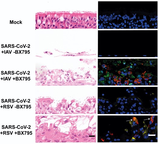 Morphological changes and virus spread in air-liquid interface cultures of human bronchial cells coinfected with severe acute respiratory syndrome coronavirus 2 (SARS-CoV-2) and influenza A virus (IAV) or SARS-CoV-2 and respiratory syncytial virus (RSV) in the presence or absence of BX795. Left column shows representative images of histological sections stained with hematoxylin and eosin of cultures coinfected with the indicated viruses at 120 hours postinfection with the indicated viruses. Right column shows representative immunofluorescence images of histological sections stained with antibodies against SARS-CoV-2 nucleocapsid (red), IAV nucleoprotein (green), and RSV fusion protein (yellow). Nuclei were stained using 4′,6-diamidino-2-phenylindole (DAPI). White arrows indicate cells positive for both SARS-CoV-2 and RSV antigens. Images are representative of 3 independent experiments. Scale bars represent 20 μm.