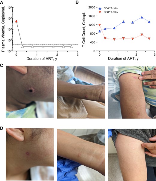 Clinical presentation and characteristic in a woman with human immunodeficiency virus (HIV) and mild mpox infection. A, Plasma HIV viremia since diagnosis of HIV, by duration of antiretroviral therapy (ART). B, Total CD4+ and CD8+ T-cell counts since diagnosis of HIV, by duration of ART. C, D, Appearance of mpox lesions at initial presentation on 6 September 2022 (C) and at follow-up clinic visit on 28 September 2022 (D).