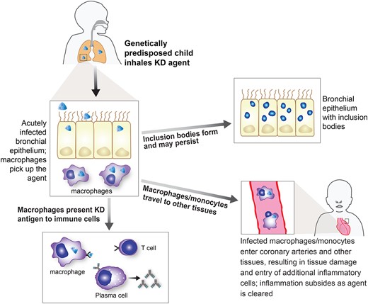 A proposed model of the pathogenesis of Kawasaki disease (KD). In this model, the KD agent is acquired via the respiratory route and infects ciliated bronchial epithelial cells, where inclusion bodies can form. It can be picked up by monocyte/macrophages and presented to the immune system, resulting in innate and acquired immune responses. Monocyte/macrophages travel through the circulation and enter coronary arteries and other tissues, with the most significant damage occurring in the coronary arteries. The immune system ultimately clears the infection, although inclusion bodies can persist.