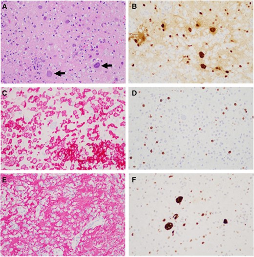 Example of immunohistochemical staining in progressive multifocal leukoencephalopathy tissue. Hematoxylin-eosin staining (A) shows infected and transformed glial cells (arrows), further highlighted by an antibody for JC polyomavirus large T antigen (B). The inflammatory reaction is illustrated by staining for macrophages (C, Iba1 antibody), T lymphocytes (D, CD3 antibody, pan–T-cell marker), and reactive astrocytes (E, GFAP antibody). Infected glial cells show accumulation of p53 tumor suppressor protein (F). Magnification 200×.