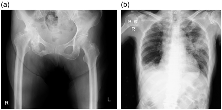 (a) A plain radiograph shows pathological central dislocation of the hip joint after radiation therapy. The right acetabulum exhibits sclerotic changes, suggesting bone necrosis. (b) An anteroposterior plain chest radiograph shows a residual pneumonia shadow in the middle of the left lung.