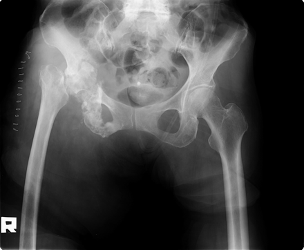 Postoperative plain film demonstrating a femoral neck pseudarthrosis resembling an intracapsular femoral neck fracture.