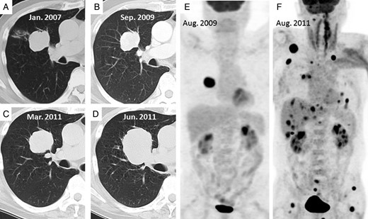 (A–D) Computed tomography (CT) examinations of the tumor in January 2007, September 2009, March 2011 and June 2011, respectively. (E) In August 2009, abnormal 18F-fluorodeoxyglucose (FDG) uptake is shown only in the tumor. (F) A FDG-positron emission tomography (PET) examination shows multiple metastases in August 2011 after recurrence.