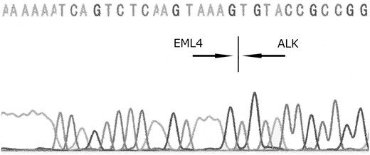 EML4-ALK fusion gene (variant 5a) is detected in the tumor tissue by direct sequencing.