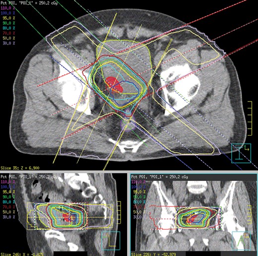 Dose distribution of the boost plan for a patient with right posterolateral bladder tumor. Boost irradiation of 25 Gy after 40 Gy whole-bladder irradiation. Clinical target volume (CTV) (red mesh), planning target volume (PTV) (cyan contour), bladder (yellow-green contour) and rectum (purple contour).