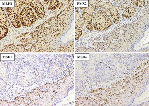 Representative immunohistochemical staining of MMR protein expression in the cancer tissue of the patient (Case 1) with loss of MSH2/MSH6. (magnification ×100).
