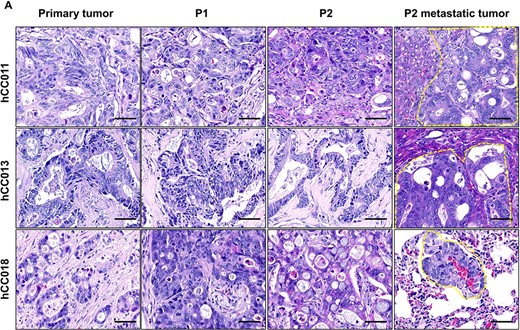 Histological comparison between primary tumours and PDX tumours. (A) Representative H&E images for three cases of metastatic CRC and their PDX models. Scale bars, 50 μm in black.