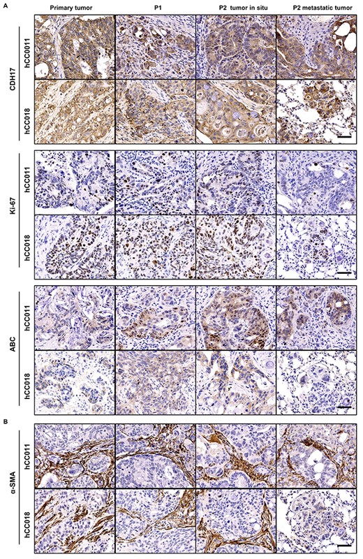 Biomarker expression comparison between primary and PDX tumours. (A) IHC analysis of the normal biomarker (CDH17, ki-67, ABC) expression levels in the hCC0011 and hCC018 metastatic CRC and their PDX models. (B) IHC analysis of α-SMA expression levels of the 2 cases of metastatic CRC and their PDX models. IHC, immunohistochemistry; ABC, Active β-catenin; α-SMA, α-smooth muscle actin. Scale bars, 50 μm in black.