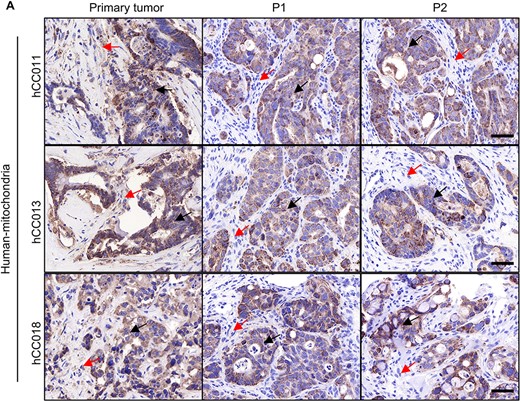 Origin of the stromal cells in PDX tumours. (A) IHC staining with a human-specific mitochondrial antibody in both the primary tumours and PDX tumours. Human tumour cells were indicated by black arrows, and stromal cells were indicated by red arrows. Scale bars, 50 μm in black.